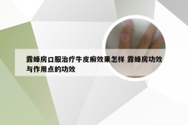 露蜂房口服治疗牛皮癣效果怎样 露蜂房功效与作用点的功效