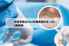 中央电视台2023年银屑病方法 cctv2银屑病