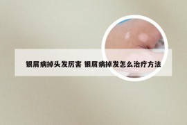 银屑病掉头发厉害 银屑病掉发怎么治疗方法