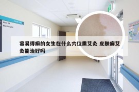 容易得癣的女生在什么穴位熏艾灸 皮肤癣艾灸能治好吗