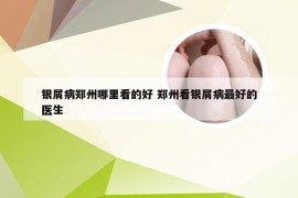 银屑病郑州哪里看的好 郑州看银屑病最好的医生