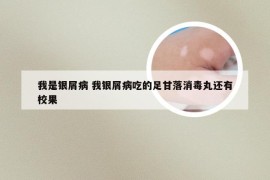 我是银屑病 我银屑病吃的足甘落消毒丸还有校果