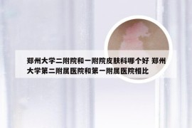 郑州大学二附院和一附院皮肤科哪个好 郑州大学第二附属医院和第一附属医院相比