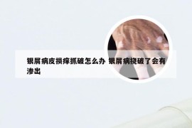 银屑病皮损痒抓破怎么办 银屑病挠破了会有渗出