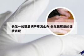 头发一长银屑病严重怎么办 头发银屑病的症状表现
