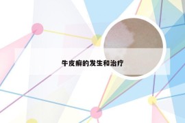 牛皮癣的发生和治疗