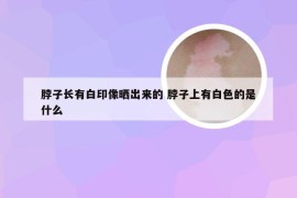 脖子长有白印像晒出来的 脖子上有白色的是什么