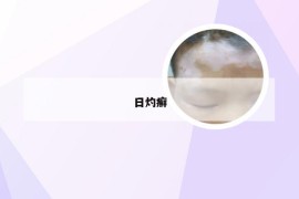 日灼癣