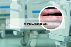 牛皮癣人能喝姜汤吗