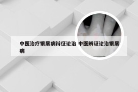 中医治疗银屑病辩征论治 中医辨证论治银屑病
