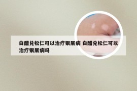 白醋兑松仁可以治疗银屑病 白醋兑松仁可以治疗银屑病吗