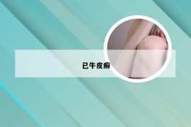 已牛皮癣