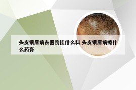 头皮银屑病去医院挂什么科 头皮银屑病擦什么药膏
