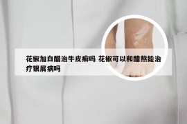 花椒加白醋治牛皮癣吗 花椒可以和醋熬能治疗银屑病吗