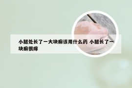 小腿处长了一大块癣该用什么药 小腿长了一块癣很痒