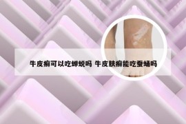 牛皮癣可以吃蝉蜕吗 牛皮肤癣能吃蚕蛹吗