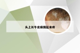 头上长牛皮癣摸起来疼