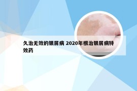 久治无效的银屑病 2020年根治银屑病特效药