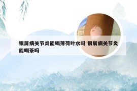 银屑病关节炎能喝薄荷叶水吗 银屑病关节炎能喝茶吗