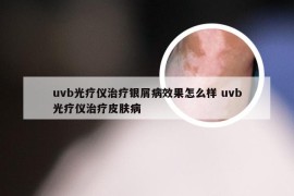uvb光疗仪治疗银屑病效果怎么样 uvb光疗仪治疗皮肤病
