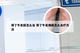 得了牛皮藓怎么治 得了牛皮病癣怎么治疗方法