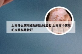 上海什么医院皮肤科比较出名 上海哪个医院的皮肤科比较好