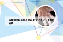 后背圆形癣是什么原因 后背上长了一个圆形的癣