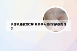 头部银屑病发红痒 银屑病头皮红的内因是什么
