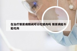 在治疗银屑病期间可以吃猪肉吗 银屑病能不能吃肉