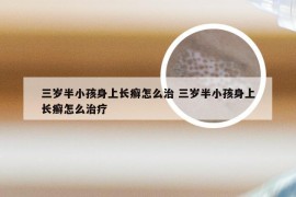 三岁半小孩身上长癣怎么治 三岁半小孩身上长癣怎么治疗