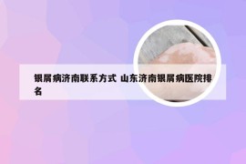 银屑病济南联系方式 山东济南银屑病医院排名