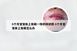 6个月宝宝身上有癣一样的块状斑 6个月宝宝身上有癣怎么办