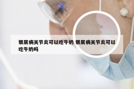 银屑病关节炎可以吃牛奶 银屑病关节炎可以吃牛奶吗