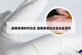 副银屑病如何治愈 副银屑病治愈后会复发吗