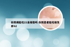 白斑病能吃21金维他吗 白斑患者能吃维生素b2