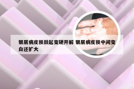银屑病皮损鼓起变硬开解 银屑病皮损中间变白还扩大