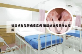 银屑病复发得病率高吗 银屑病复发是什么原因