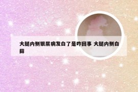 大腿内侧银屑病发白了是咋回事 大腿内侧白藓
