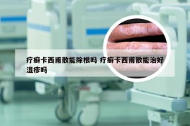 疗癣卡西甫散能除根吗 疗癣卡西甫散能治好湿疹吗