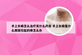 手上长癣怎么治疗买什么药膏 手上长癣是什么原因引起的痒怎么办