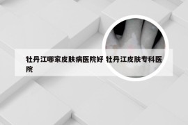 牡丹江哪家皮肤病医院好 牡丹江皮肤专科医院