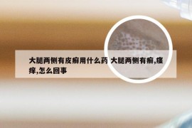 大腿两侧有皮癣用什么药 大腿两侧有癣,瘙痒,怎么回事