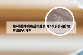 维a酸擦牛皮癣越擦越多 维a酸乳膏治疗银屑病多久见效