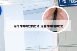 治疗白斑有效的方法 治愈白斑的神效方