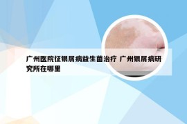 广州医院征银屑病益生菌治疗 广州银屑病研究所在哪里