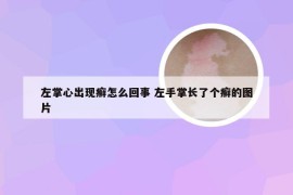 左掌心出现癣怎么回事 左手掌长了个癣的图片