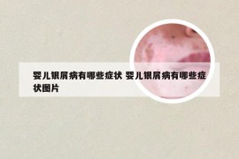 婴儿银屑病有哪些症状 婴儿银屑病有哪些症状图片