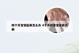 四个月宝宝起癣怎么办 4个月的宝宝皮肤长癣