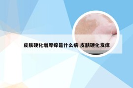 皮肤硬化增厚痒是什么病 皮肤硬化发痒