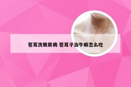 苍耳洗银屑病 苍耳子治牛癣怎么吃